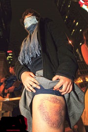 17歲中六生阿B(化名),昨戴着口罩掀起裙子向傳媒展示傷勢,左邊大腿大幅瘀傷。她指雖然被警棍打時很痛,但相信有更多人傷得更嚴重,希望佔領者要堅持,不要放棄。