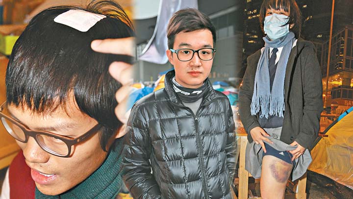 港大生Samuel周日被打至頭破血流(左圖),頭殼縫了兩針。