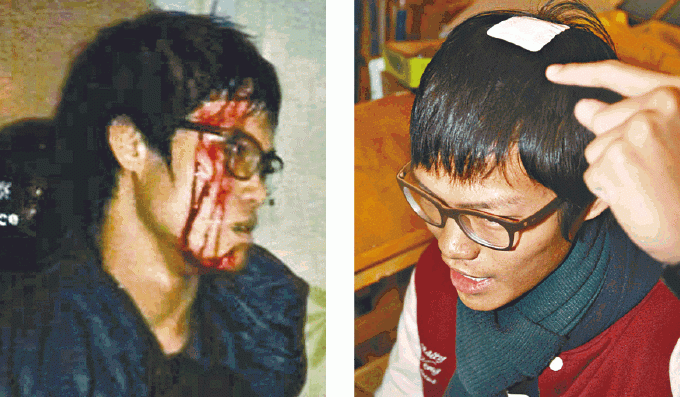 港大生Samuel周日被打至頭破血流(左圖),頭殼縫了兩針。